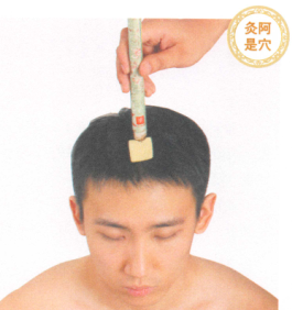 头痛艾灸