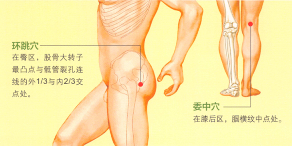 坐骨神经痛艾灸