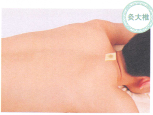 慢性支气管炎艾灸