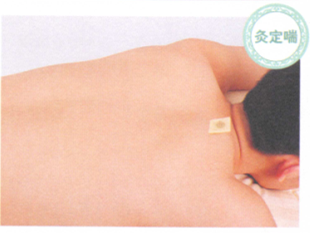 慢性支气管炎艾灸