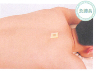 慢性支气管炎艾灸