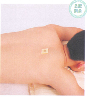 慢性支气管炎艾灸