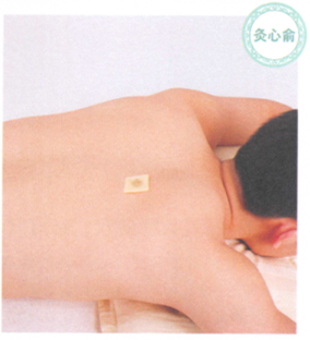 慢性支气管炎艾灸