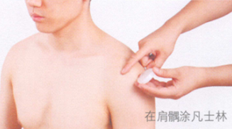 中风后遗症艾灸