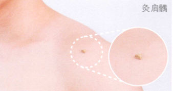 中风后遗症艾灸