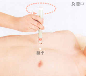 消化性溃疡艾灸