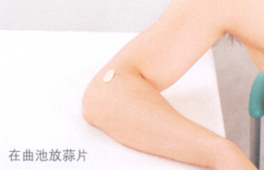 神经性皮炎艾灸