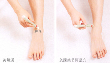 踝关节扭伤艾灸