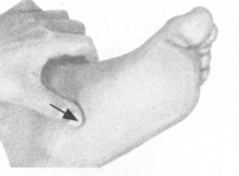 腰椎间盘突出症按摩