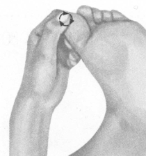 腰椎间盘突出症按摩