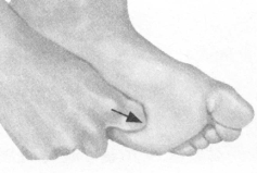 腰椎间盘突出症按摩