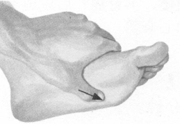 前列腺疾病按摩