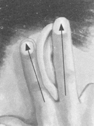 腰椎间盘突出症按摩