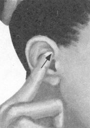 腰椎间盘突出症按摩