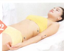 中风后遗症拔罐