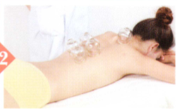 三叉神经痛拔罐