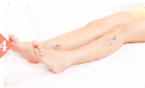 疲劳综合征拔罐