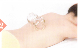 消化性溃疡拔罐