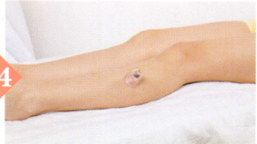 急性阑尾炎拔罐