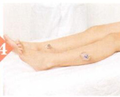 中风后遗症拔罐