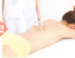 慢性胆囊炎拔罐