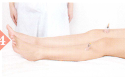 消化性溃疡拔罐