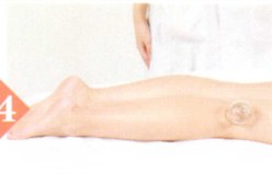 类风湿性关节炎拔罐