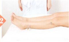 坐骨神经痛拔罐