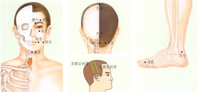 中风后遗症刮痧
