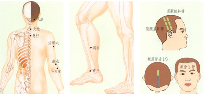 皮肤瘙痒症刮痧